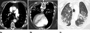 Hình 2: Một bệnh nhân COVID+ bị thuyên tắc phổi hai bên có D dimer> 10.000 bốn ngày sau khi nhập viện.