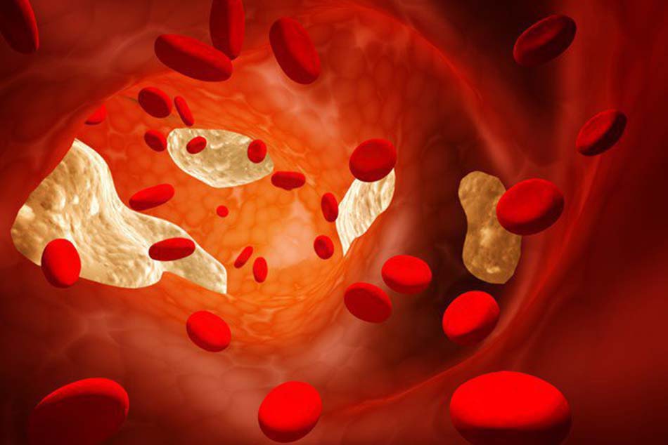 Nồng độ cholesterol trong máu cao