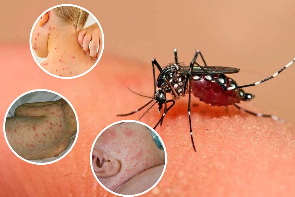 Muỗi cái Aedes aegypti là vector truyền bệnh sốt xuất huyết Dengue
