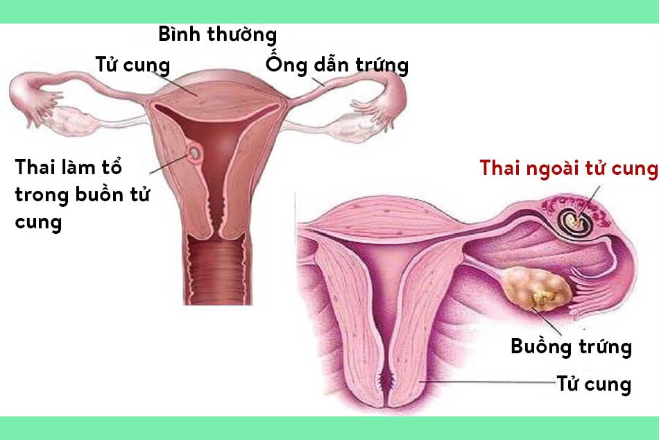 Hình ảnh mang thai bình thường và thai ngoài tử cung