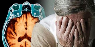 Bệnh Alzheimer là gì?