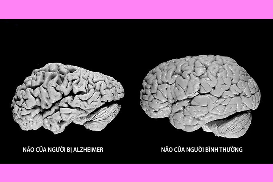 Dấu hiệu bệnh Alzheimer