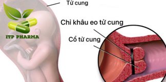 Khâu eo tử cung - Phương pháp giúp ngăn ngừa sinh non hiệu quả