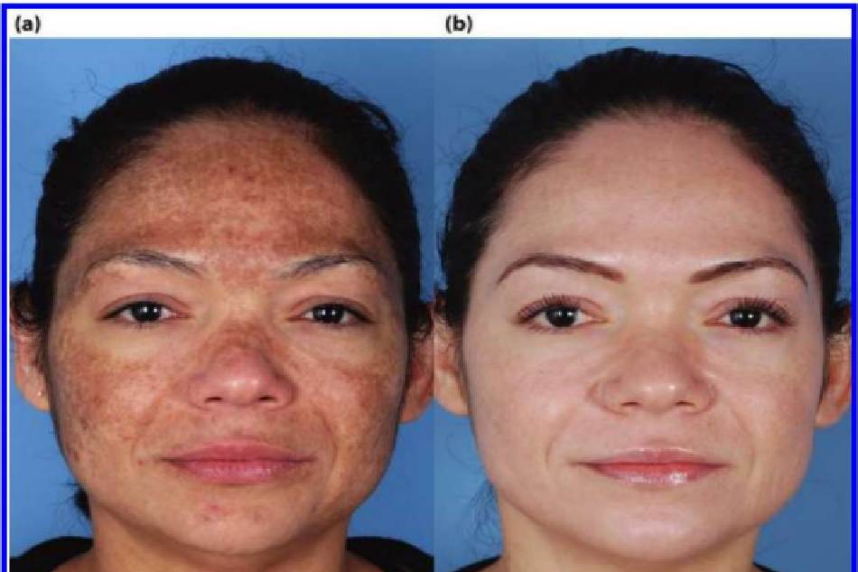Hình 7.5 (a) Bệnh nhân có làn da được phân loại là trắng lệch màu (sẫm màu), dày trung bình và nhờn. Cô được chẩn đoán mắc tăng sắc tố sau viêm nặng và nám da. (b)