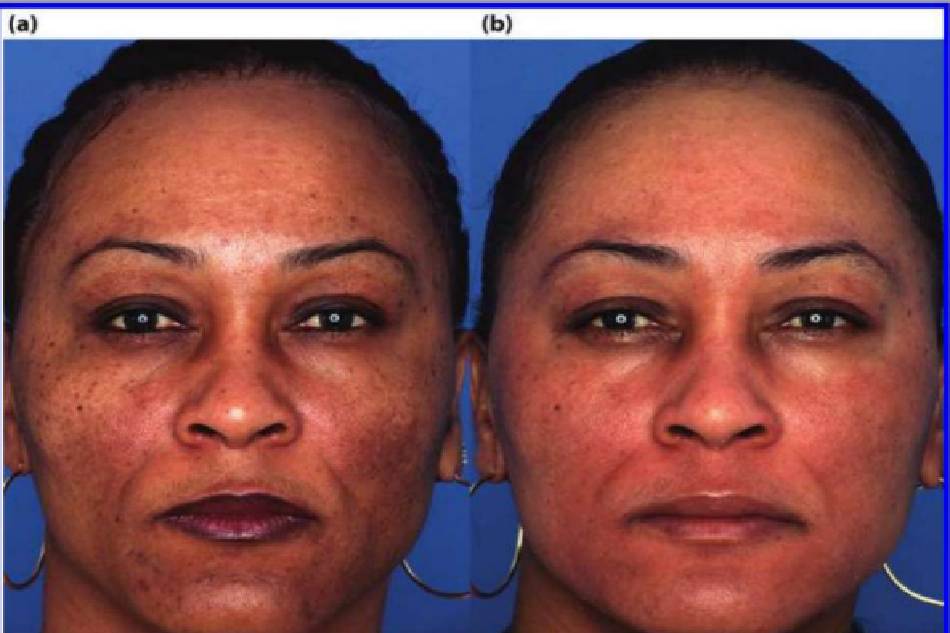 Hình 7.6 (a) Trước. Bệnh nhân có da được phân loại là da đen (trung bình), dày trung bình và nhờn. Cô được chẩn đoán mắc trứng cá đỏ và tăng sắc tố sau viêm. (b) Một năm sau. Bệnh nhân được điều trị bằng HQ-based ZO Medical Skin Health