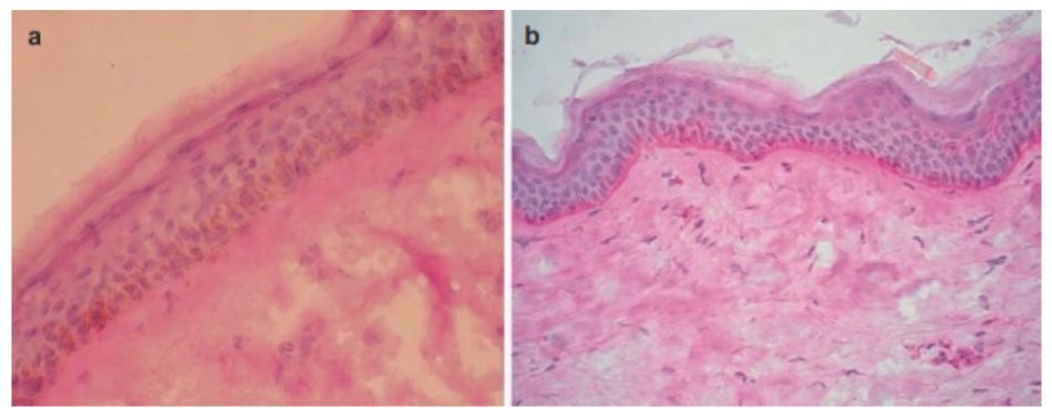 PAS stain sections showing an absence of basal membrane in melasma skin (a), the integrity of the basal membrane in the perilesional skin of the same patient (b