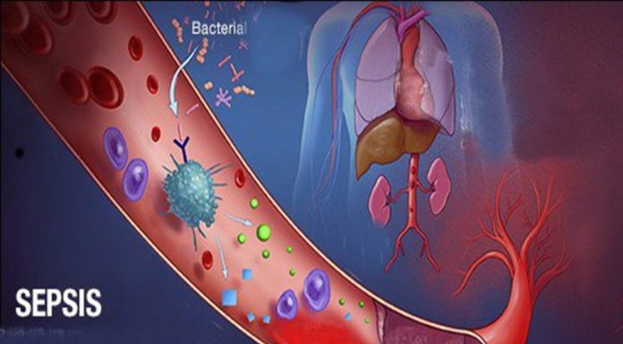 sepsis ở trẻ em