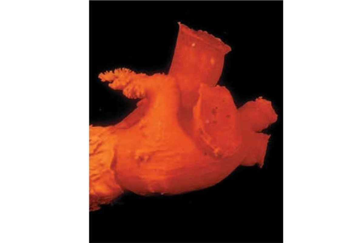 Hình 30.1 Trụ nội tâm mạc của tim trái cho thấy “ruột thừa” của nhĩ trái (tiểu nhĩ trái) có nhiều thớ cơ. Đây là nguồn huyết khối trong nhĩ trái trên bệnh nhân rung nhĩ không do bệnh van tim (Courtesy of Dr Yen Ho.)