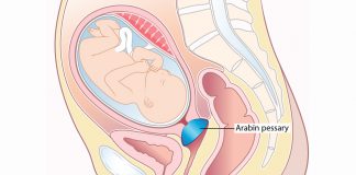 Kết quả dự phòng sinh non bằng vòng nâng cổ tử cung ở thai phụ mang đơn thai từ 14 - 32 tuần
