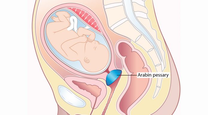 Kết quả dự phòng sinh non bằng vòng nâng cổ tử cung ở thai phụ mang đơn thai từ 14 - 32 tuần