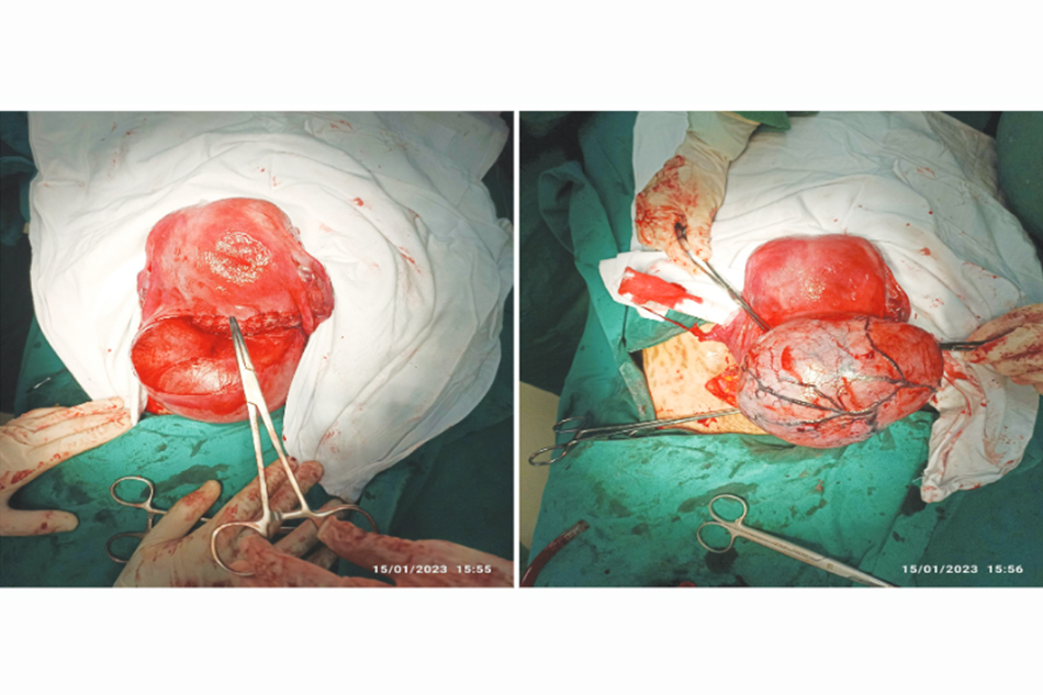 Hình 1. Hình ảnh u xơ tử cung tại vị trí mặt trước cổ tử cung phát triển về phía dây chằng rộng bên phải trước và sau khi bóc.