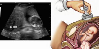 U xơ tử cung và thai nghén: báo cáo ca bệnh và tổng quan tài liệu