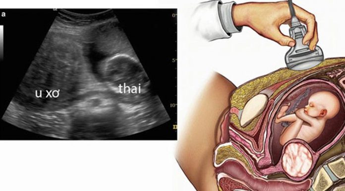 U xơ tử cung và thai nghén: báo cáo ca bệnh và tổng quan tài liệu