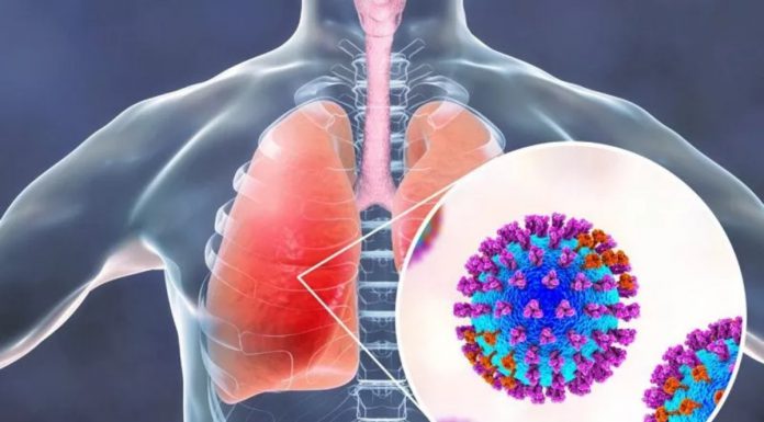 Viêm phổi do Covid 19 kèm thuyên tắc phổi cấp tính: Ca lâm sàng