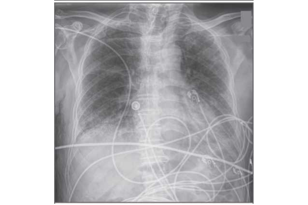 Hình 1: Xquang ngực. Hình Xquang ngực cam tay trước sau cho thay đám mờ khí loang lỗ ở phổi trái lan rộng hơn phổi phải. Đám mờ chủ yếu nam ở ngoại vi, thưa thớt ở vùng quanh rốn phổi (dấu cánh dơi ngược). Đám mờ dạng lưới đáy phổi có dãn nhẹ phế quản ở đỉnh và đáy phổi.