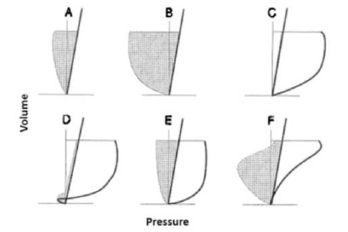 Hình 2. Đồ thị áp lực-thể tích (áp lực trên trục hoành, thể tích trên trục tung) mô tả các tương tác khác nhau giữa lưu lượng bệnh nhân và máy thở. Áp lực ở bên trái của đường chéo dày (mối quan hệ thể tích-áp lực thành ngực) do bệnh nhân tạo ra và công do bệnh nhân thực hiện (diện tích của đường cong) được tô bóng. Áp lực bên phải đường chéo dày là do máy thở tạo ra và công do máy thở thực hiện là vùng hở. (A) Một đối tượng bình thường có công thở bình thường và không có sự hỗ trợ của máy thở. (B) Một bệnh nhân bị suy hô hấp dẫn đến công thở rất cao mà không có sự hỗ trợ của máy thở. (C) Cũng chính bệnh nhân này đang được hỗ trợ thở máy và đã chuyển toàn bộ công thở vào máy thở. (D) Bệnh nhân chỉ thực hiện đủ công để kích hoạt nhịp thở được hỗ trợ—máy thở hầu như thực hiện tất cả công thở. (E) Sự hỗ trợ do máy thở cung cấp sao cho mô hình công thở của bệnh nhân giống như bình thường (A). Ngược lại, F minh họa mô hình hỗ trợ máy thở đang đặt thể tích công thở phi sinh lý lên bệnh nhân. Về mặt khái niệm, mục tiêu tối ưu hóa sự đồng bộ hóa lưu lượng máy thở của bệnh nhân là đạt được mẫu thể hiện trong E và tránh mẫu thể hiện trong F.