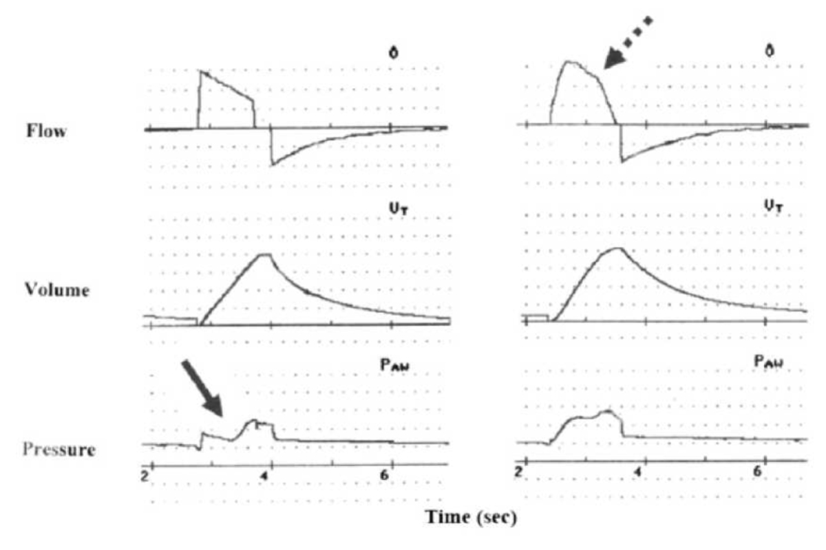 Hình 5. Tăng cường đồng bộ hóa lưu lượng với lưu lượng thay đổi, nhịp thở nhắm mục tiêu áp lực. Được mô tả là lưu lượng (V), thể tích (Vt) và áp lực đường thở (Paw) theo thời gian (giây). Bên trái: Một nhịp thở nhắm mục tiêu theo lưu lượng được cung cấp nhưng lưu lượng không đủ cho nhu cầu của bệnh nhân và sự không đồng bộ được biểu hiện bằng biểu đồ áp lực đường thở cod đi xuống sâu gần đến áp lực cơ bản (mũi tên liền). Ngược lại, nhịp thở nhắm mục tiêu áp lực ở bên phải được thiết lập để cung cấp thể tích khí lưu thông tương tự. Tuy nhiên, tính năng lưu lượng thay đổi (mũi tên nét đứt) đồng bộ hóa tốt hơn với nỗ lực của bệnh nhân, cung cấp hồ sơ áp lực đường thở dương liên tục và mượt mà hơn. In lại với sự cho phép từ Tài liệu tham khảo 48.