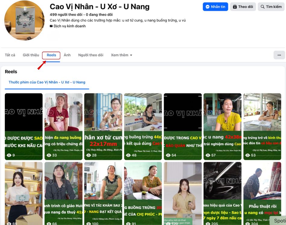 Cao Vị Nhân u xơ, u nang